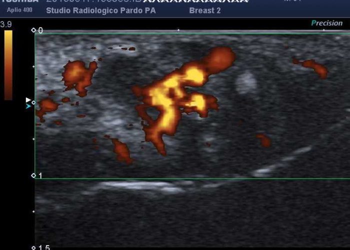 Nuova ecografia ad alta risoluzione ed ecocolordoppler per la cavità orale e la lingua