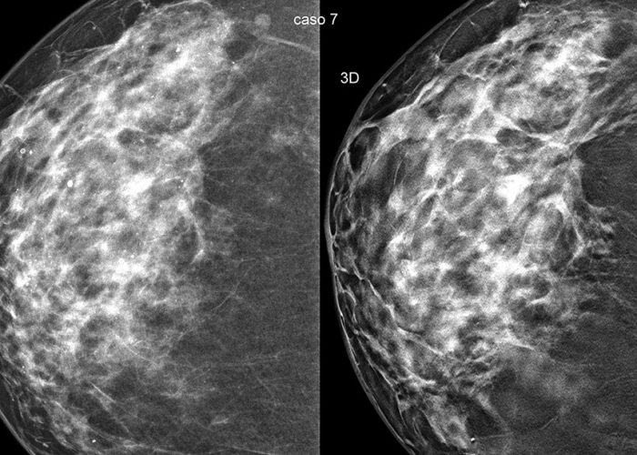 Studi confermano: la tomosintesi mammaria 3D rileva più cancri rispetto alla mammografia 2D
